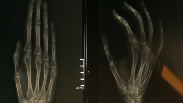 Carpal Tunnel Syndrome - Orientation