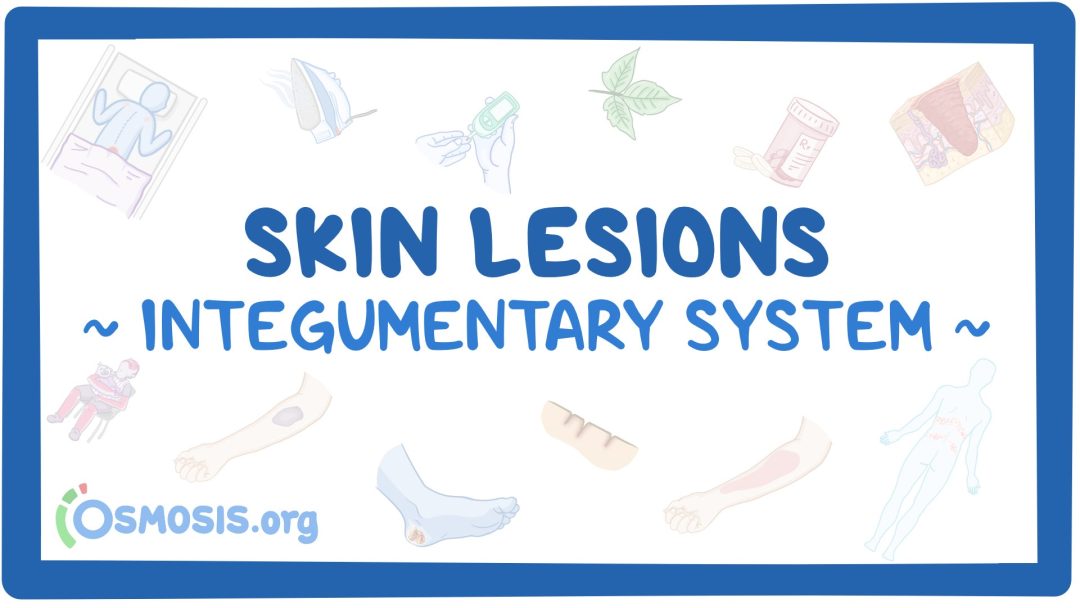 Integumentary System: Skin Lesions