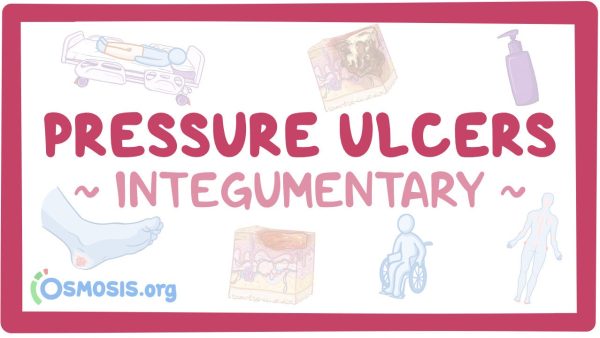 Integumentary System: Pressure Ulcers