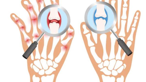 From Inflammation to Liberation: Therapies for Rheumatoid Arthritis Relief